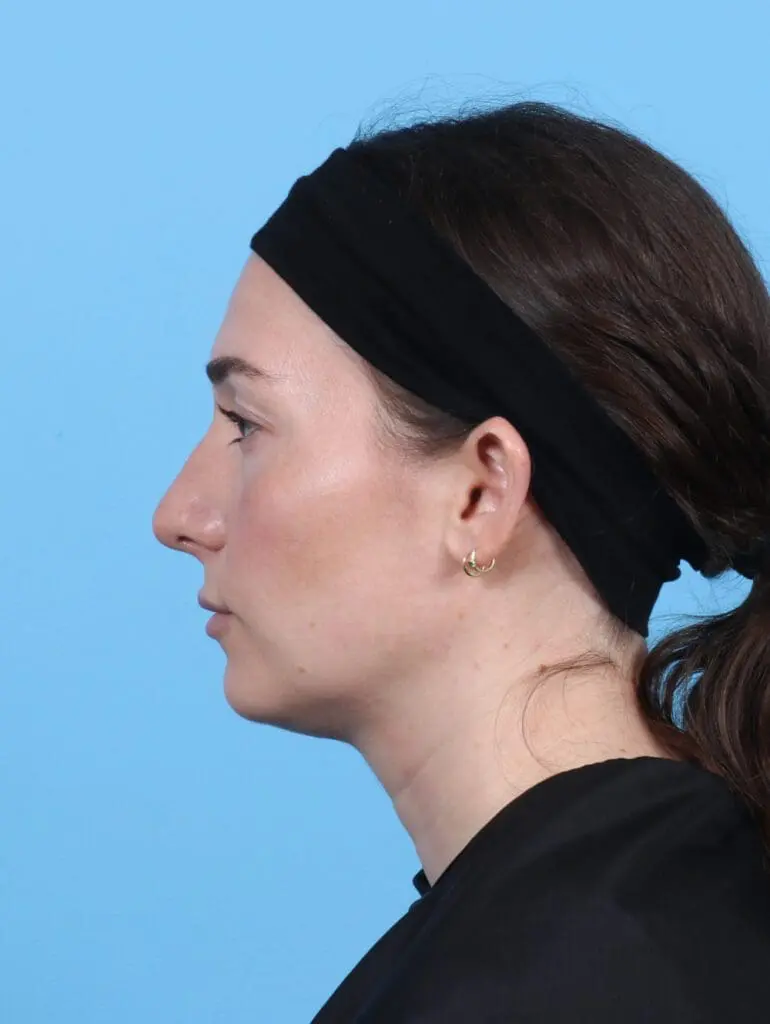 Rhinoplasty - Case 47578 - After