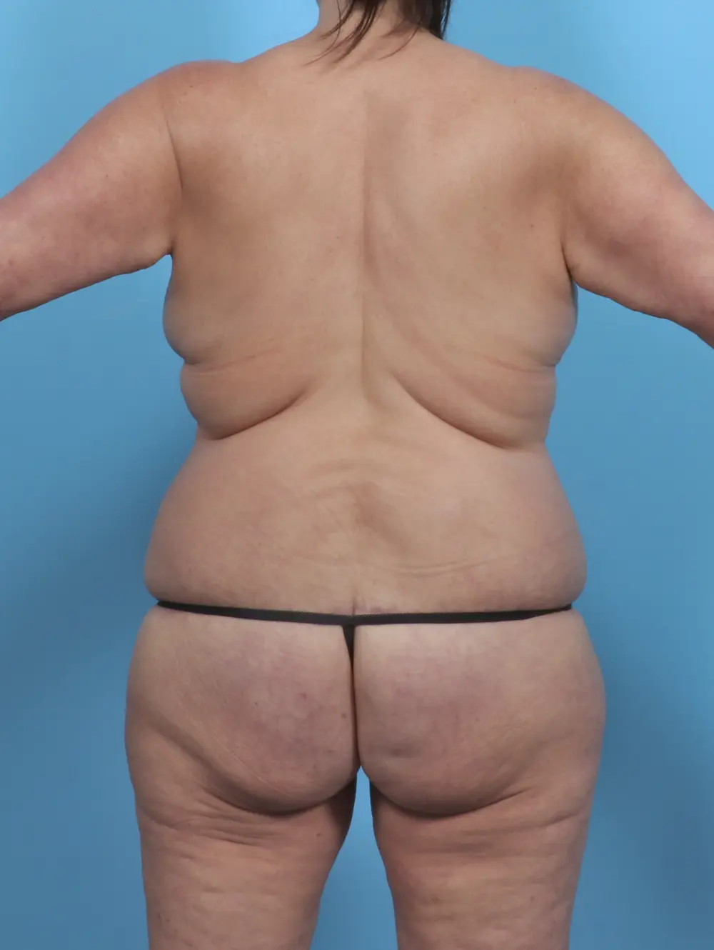 Body Lift Patient Photo - Case 47602 - after view-3