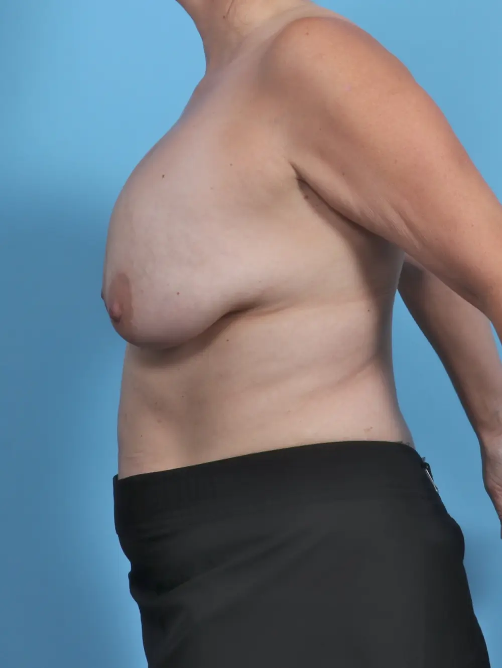 Breast Implant Revision Patient Photo - Case 47612 - before view-2