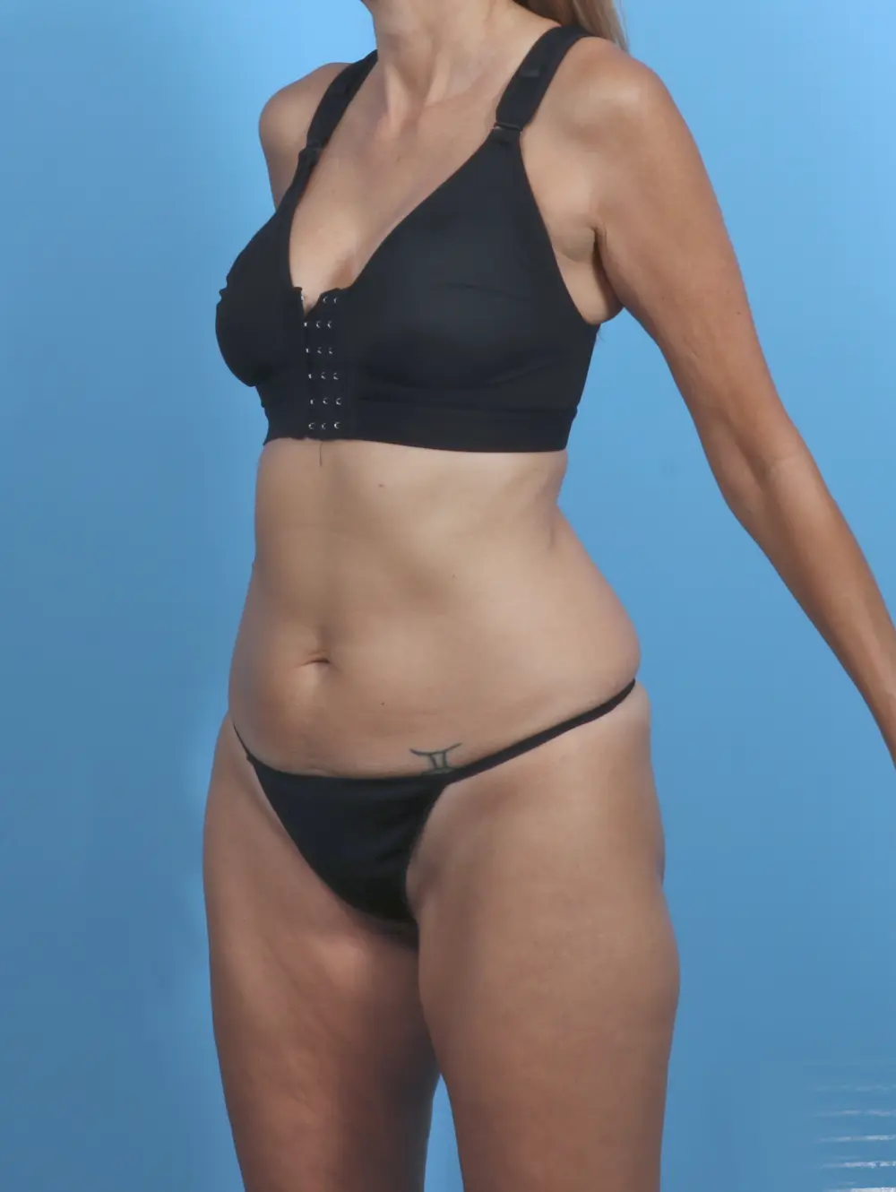 Tummy Tuck Patient Photo - Case 47620 - before view-1