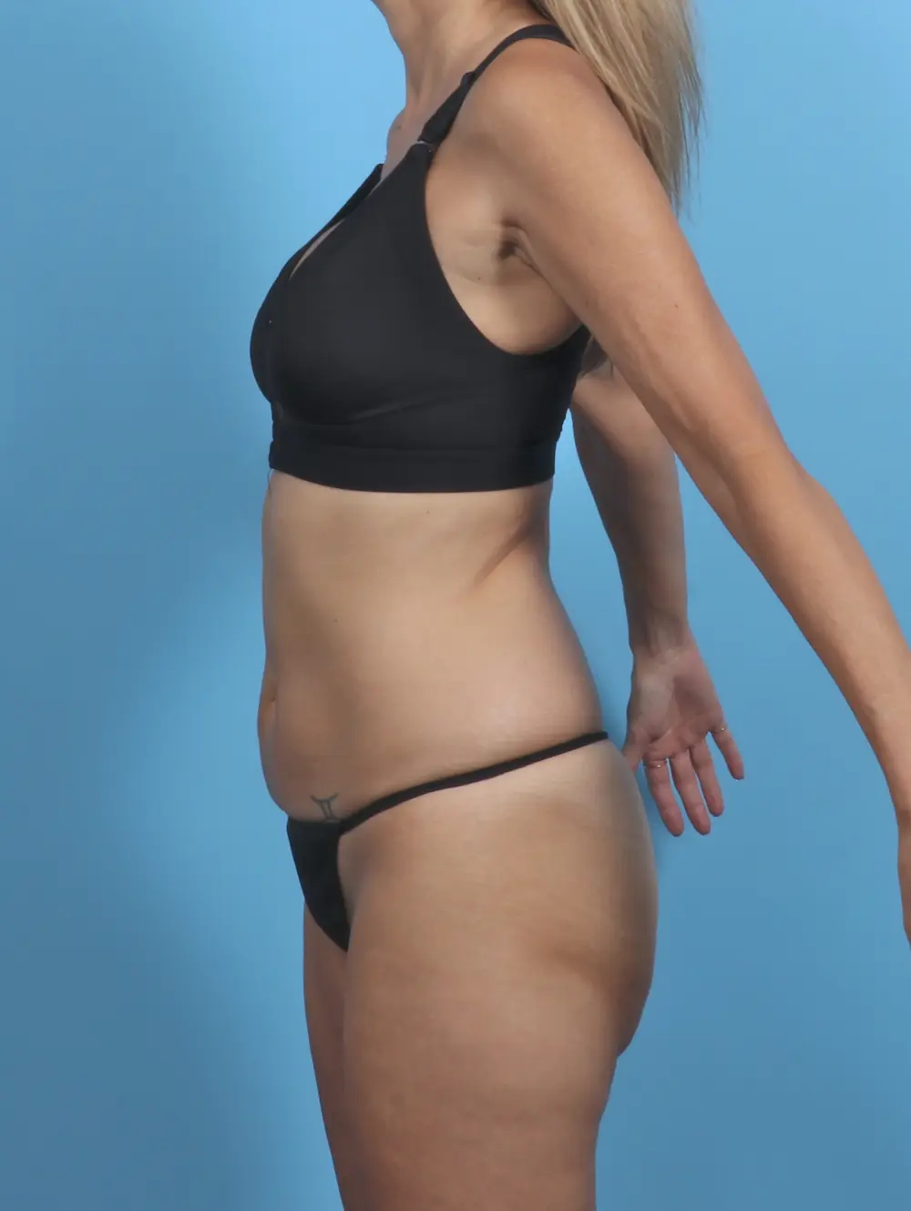 Tummy Tuck Patient Photo - Case 47620 - before view-2