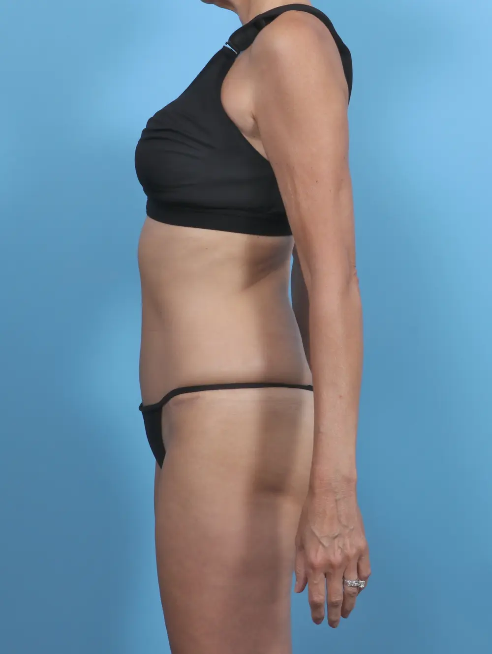 Tummy Tuck Patient Photo - Case 47620 - after view-2