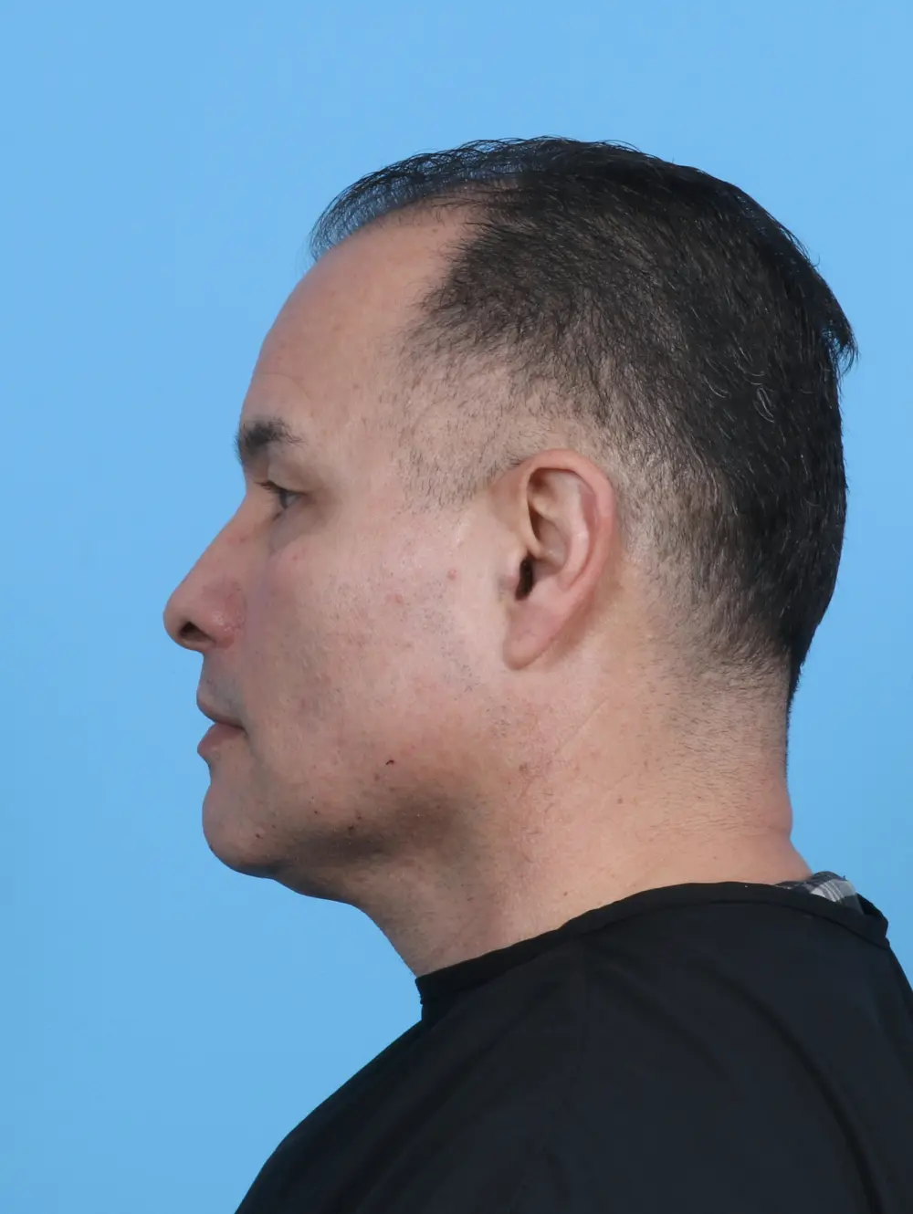 Eyelid Surgery Patient Photo - Case 47644 - before view-2