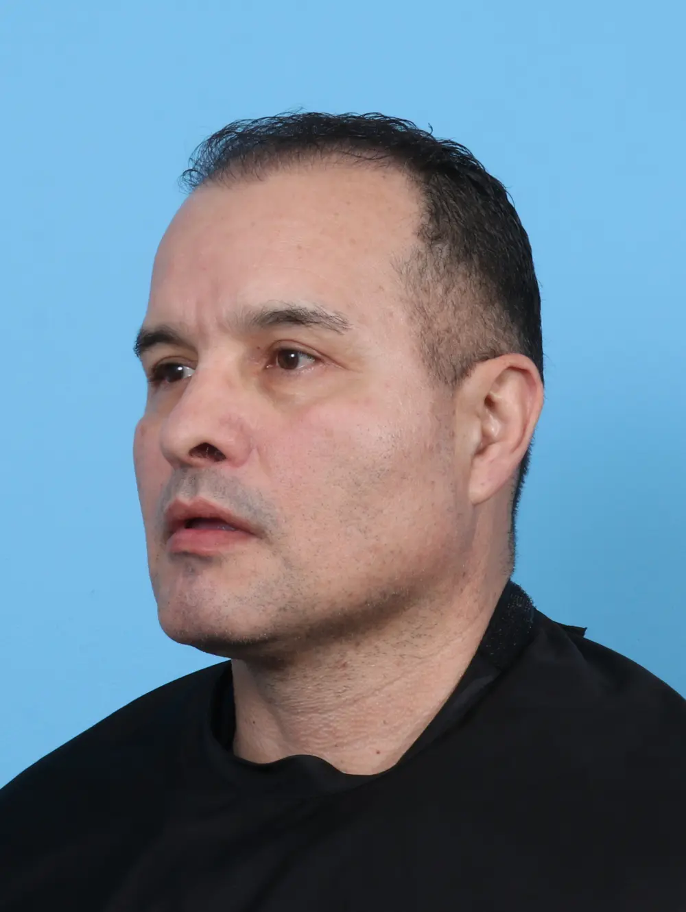 Eyelid Surgery Patient Photo - Case 47644 - after view-1