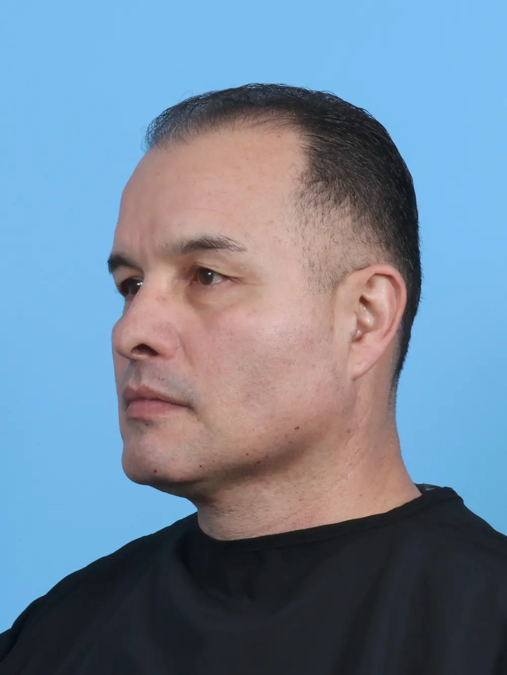 Eyelid Surgery Patient Photo - Case 47644 - before view-1