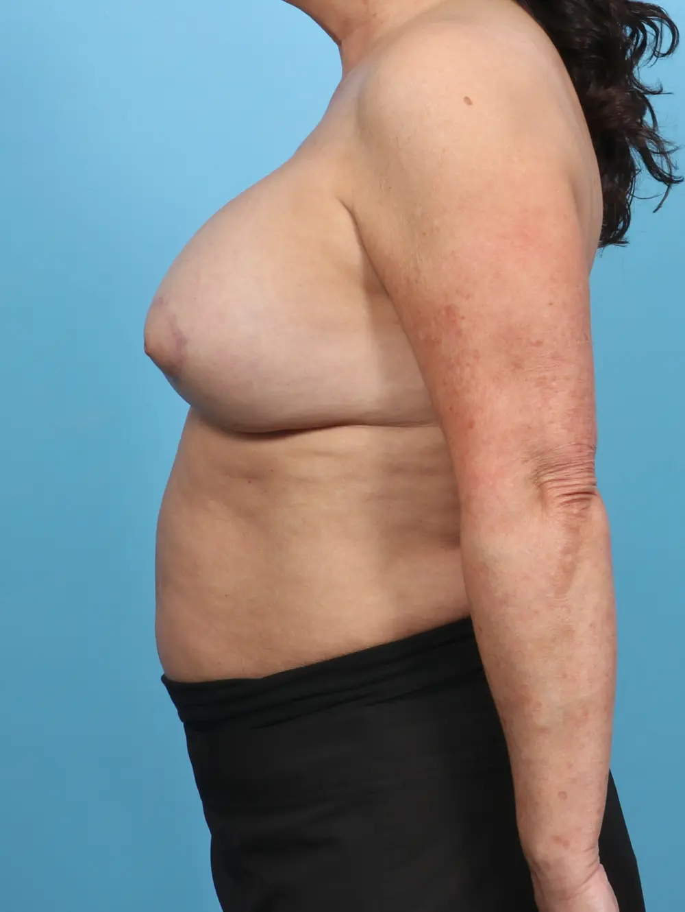 Breast Implant Revision Patient Photo - Case 47652 - after view-2