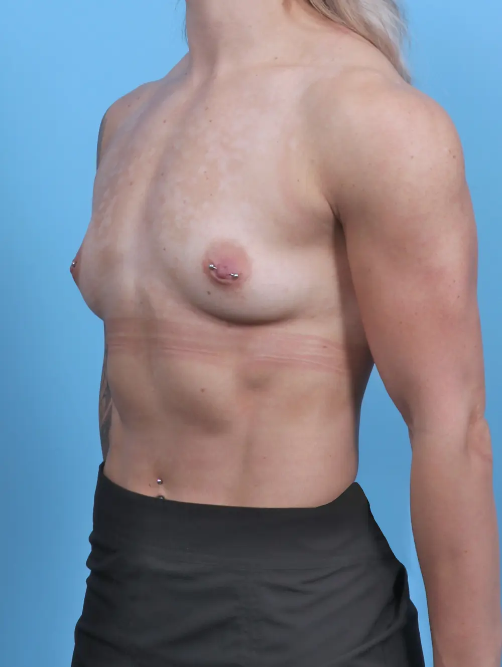 Breast Augmentation Patient Photo - Case 47668 - before view-1