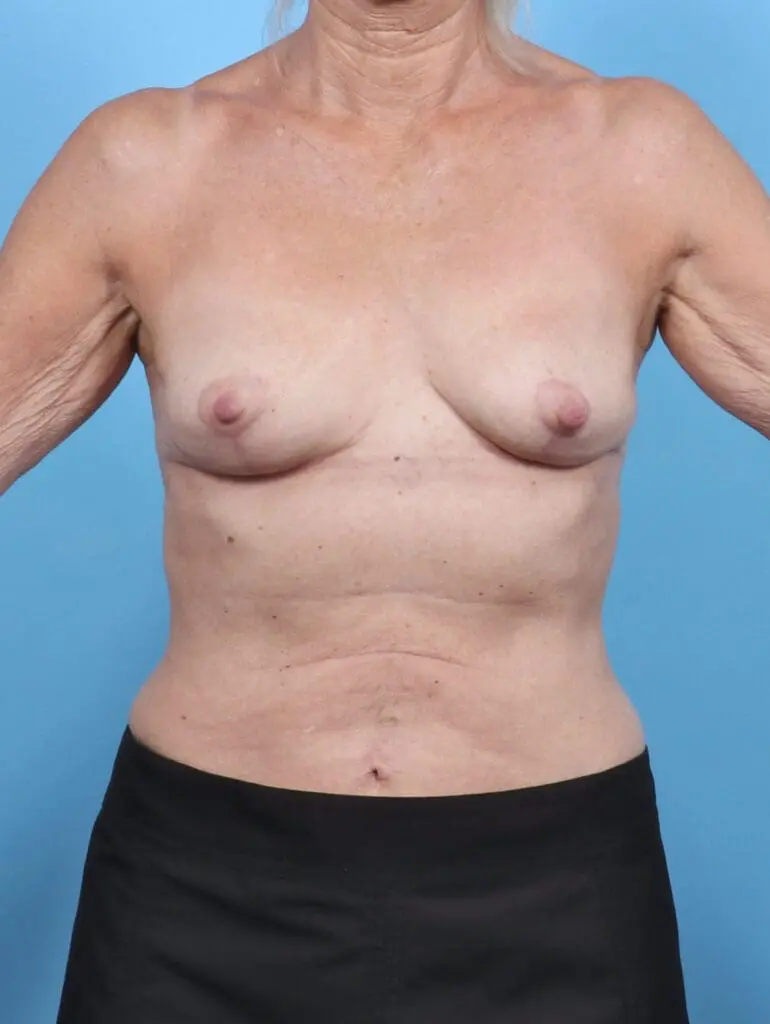 Breast Implant Removal - Case 47676 - After