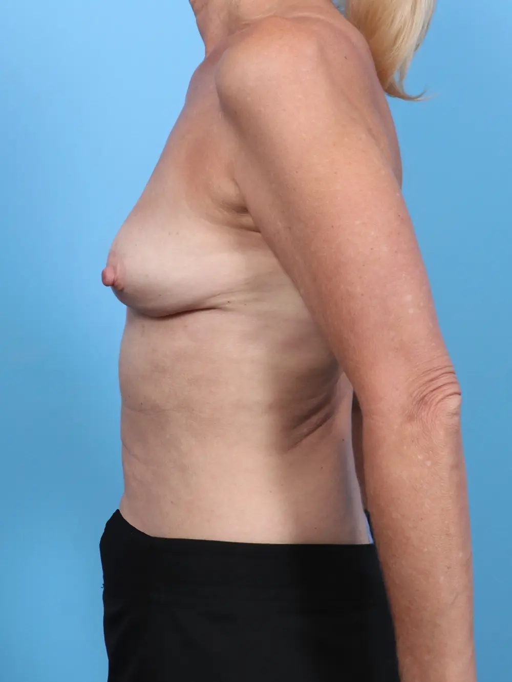 Breast Implant Removal Patient Photo - Case 47676 - after view-2