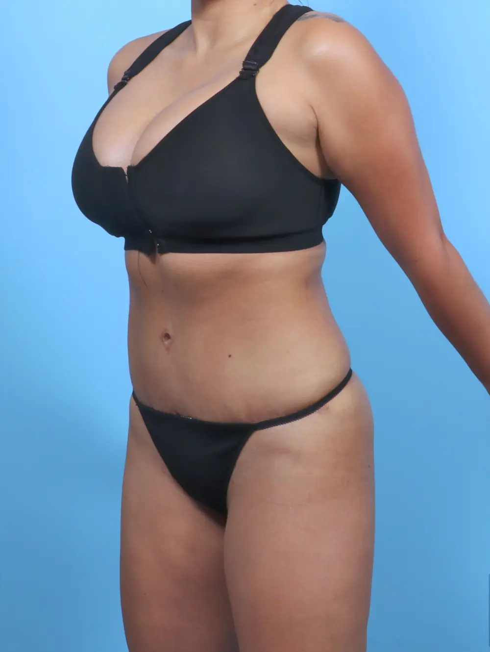 Tummy Tuck Patient Photo - Case 47685 - after view-1