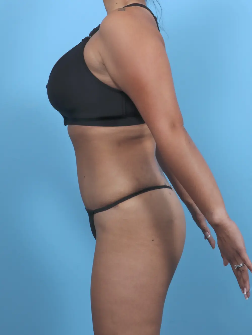 Tummy Tuck Patient Photo - Case 47685 - after view-2