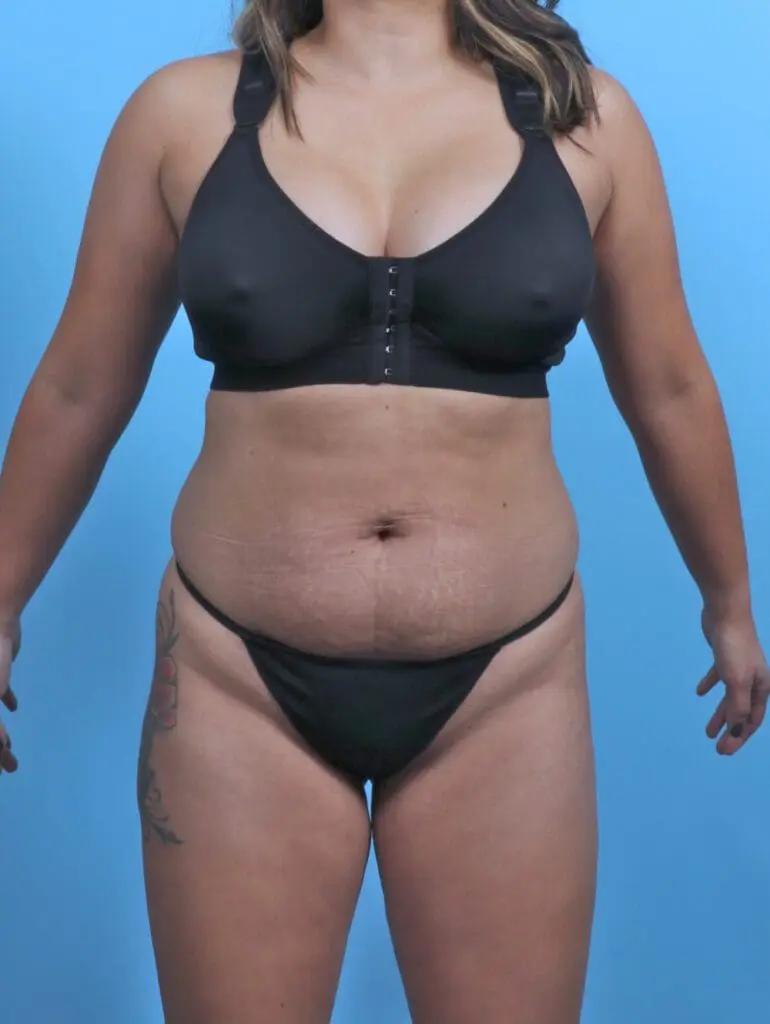 Tummy Tuck - Case 47685 - Before