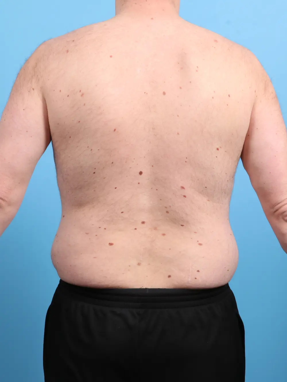 Body Lift Patient Photo - Case 47695 - before view-3