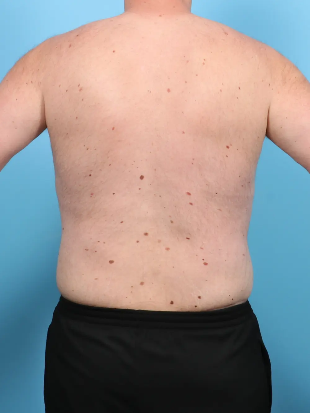 Body Lift Patient Photo - Case 47695 - after view-3