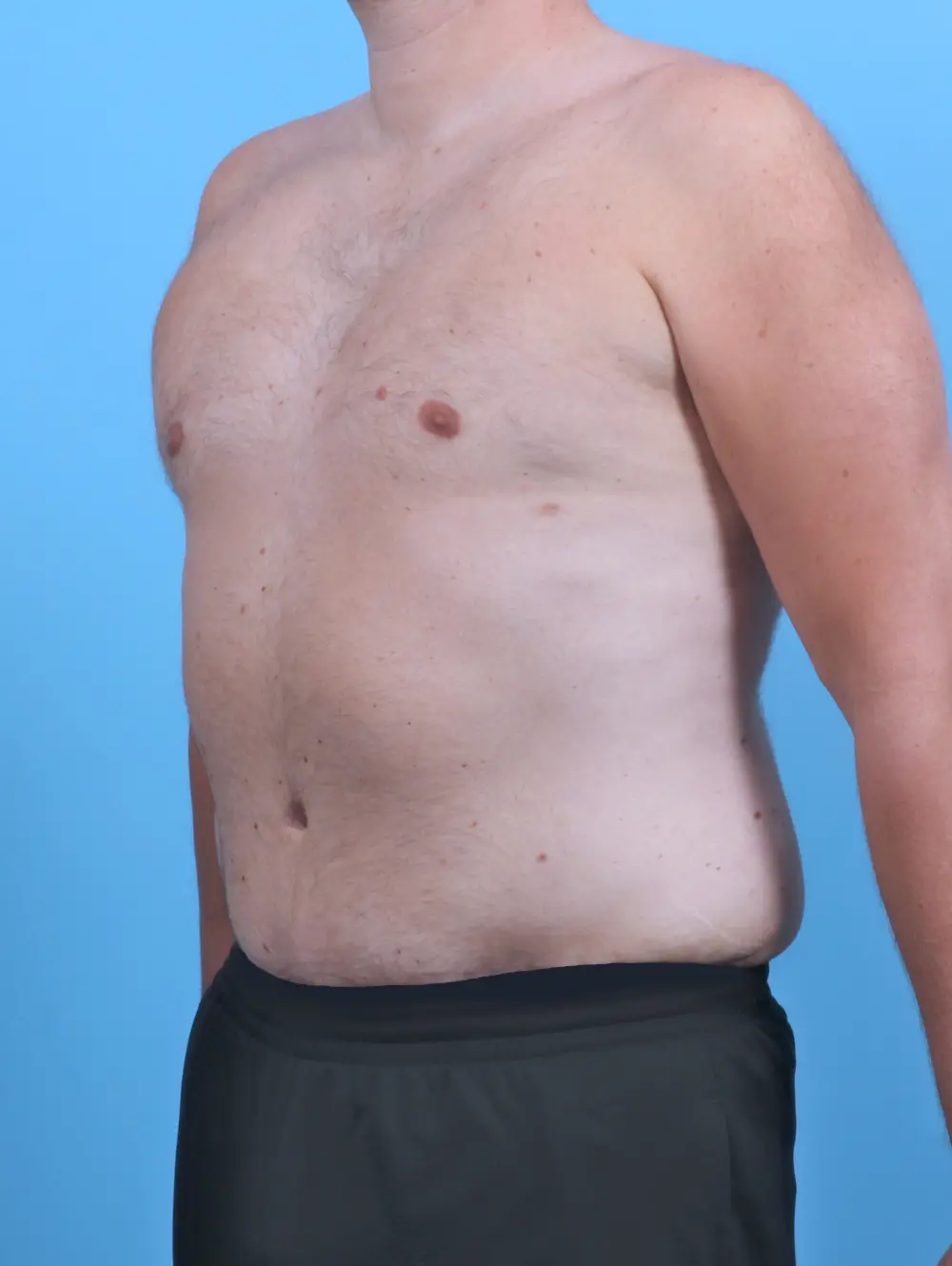 Body Lift Patient Photo - Case 47695 - after view-1