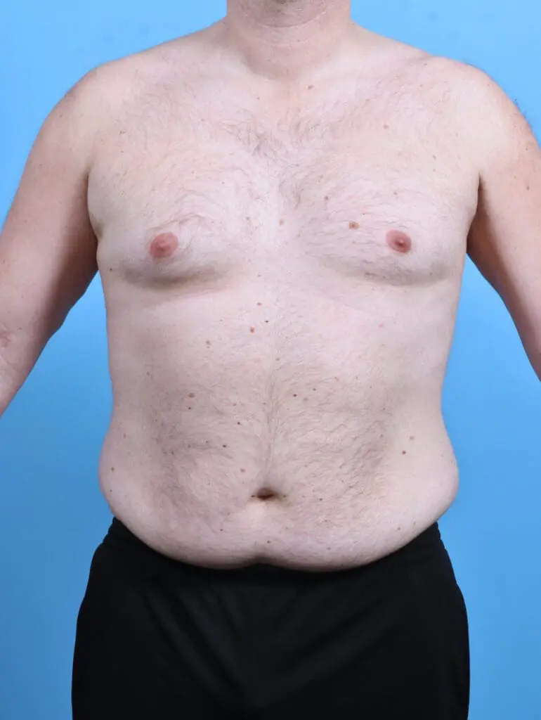 Body Lift - Case 47695 - Before