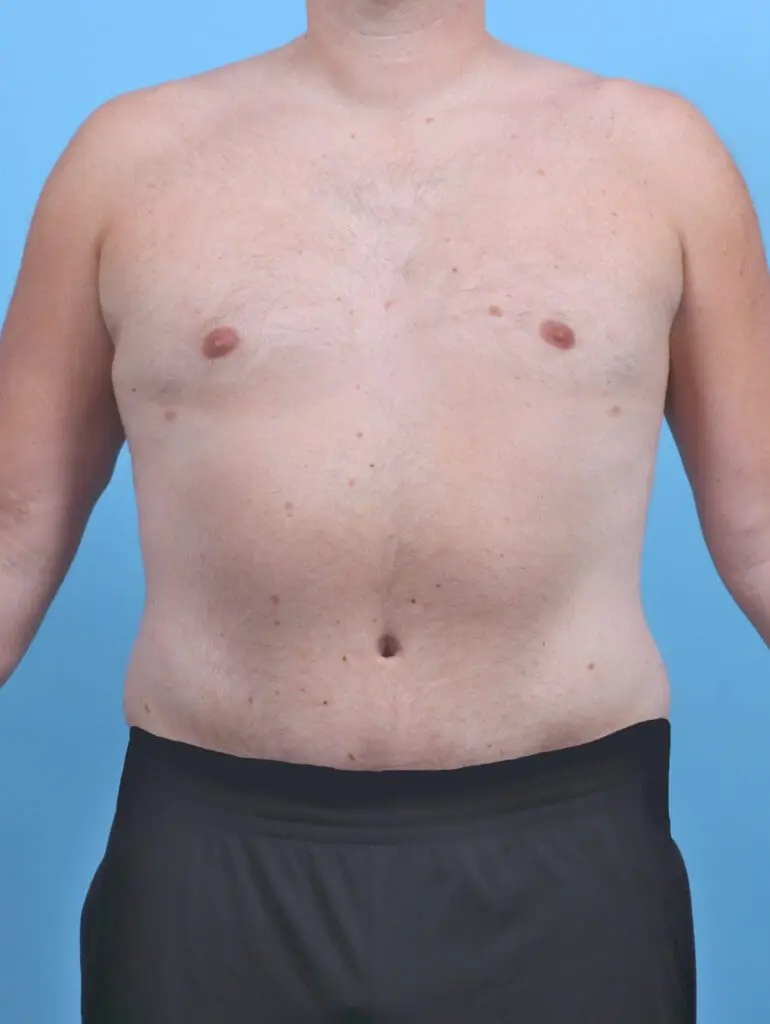 Body Lift - Case 47695 - After