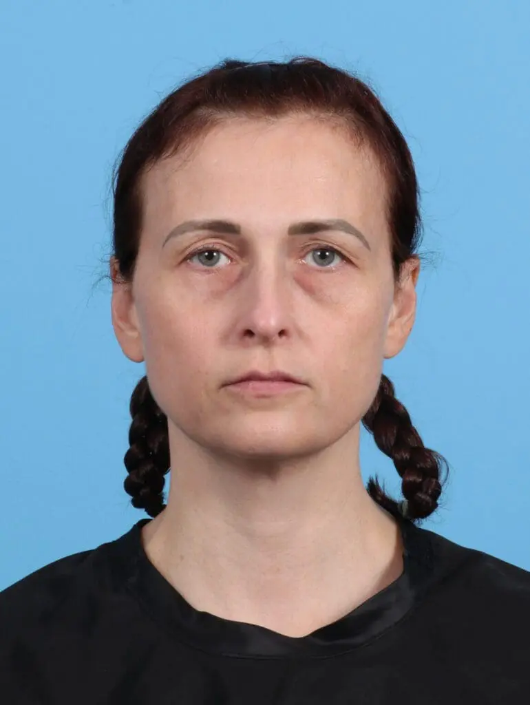 Eyelid Surgery - Case 47737 - Before