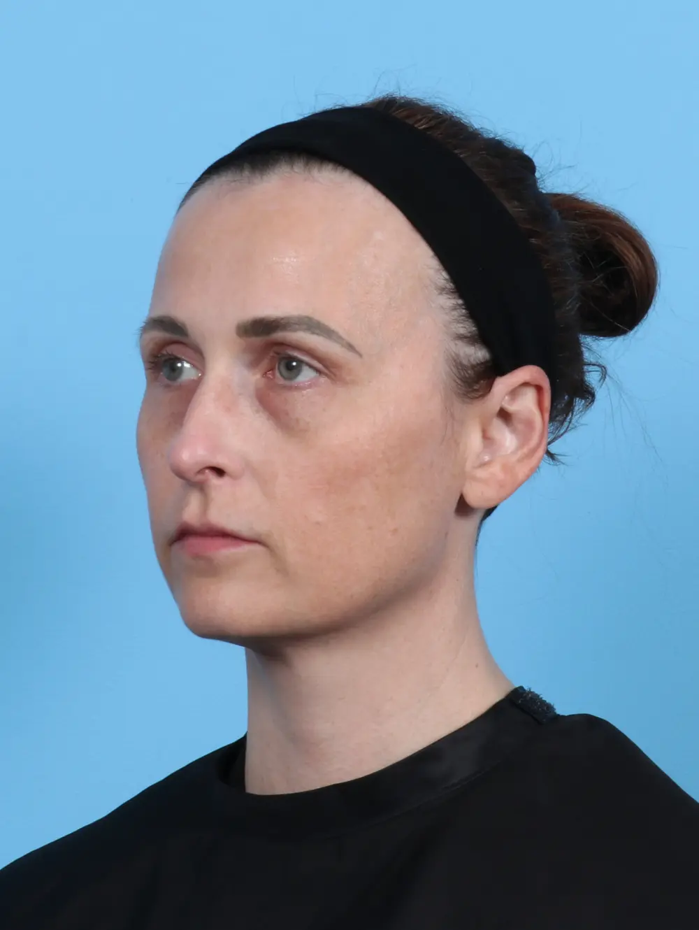 Eyelid Surgery Patient Photo - Case 47737 - after view-1