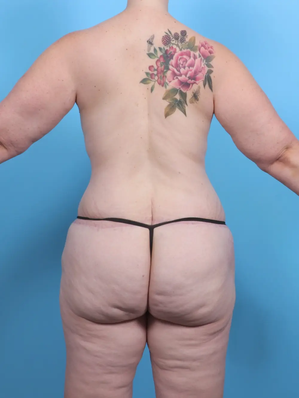 After Weight Loss Patient Photo - Case 47720 - after view-3