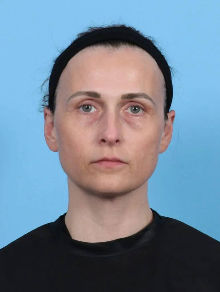 Eyelid Surgery - Case 47737 - After