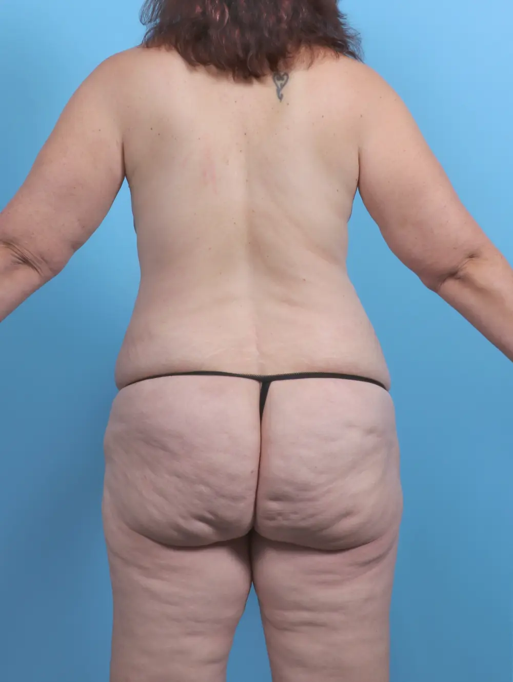After Weight Loss Patient Photo - Case 47720 - before view-3