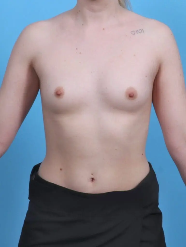 Breast Augmentation - Case 47747 - Before