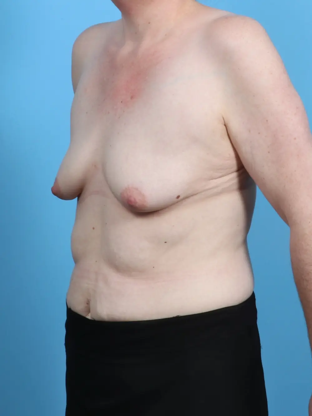 Breast Lift/Reduction with Implants Patient Photo - Case 47755 - before view-1
