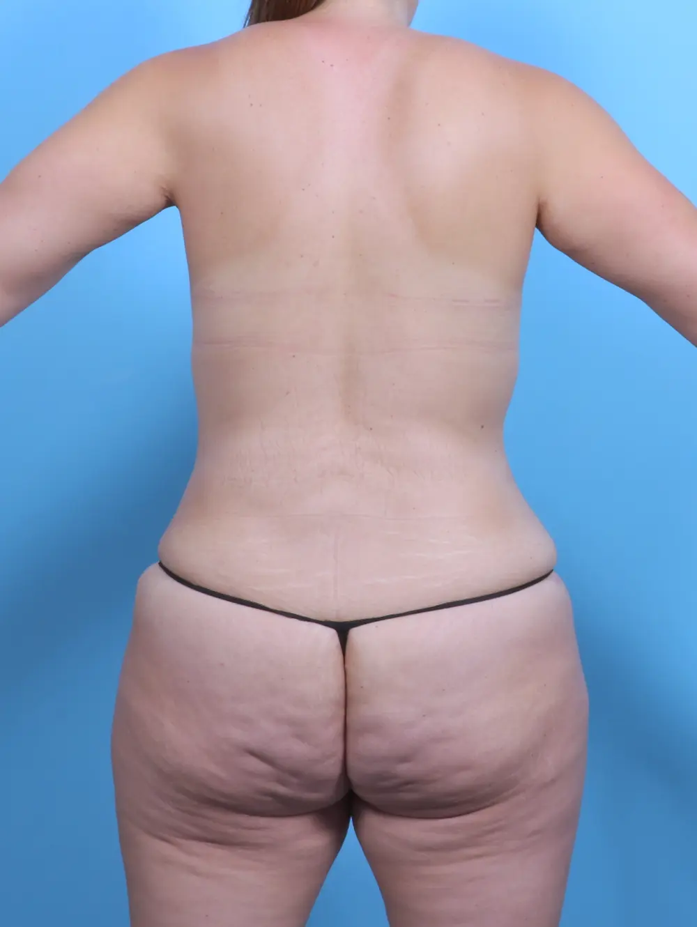 Breast Implant Revision Patient Photo - Case 47763 - after view-3