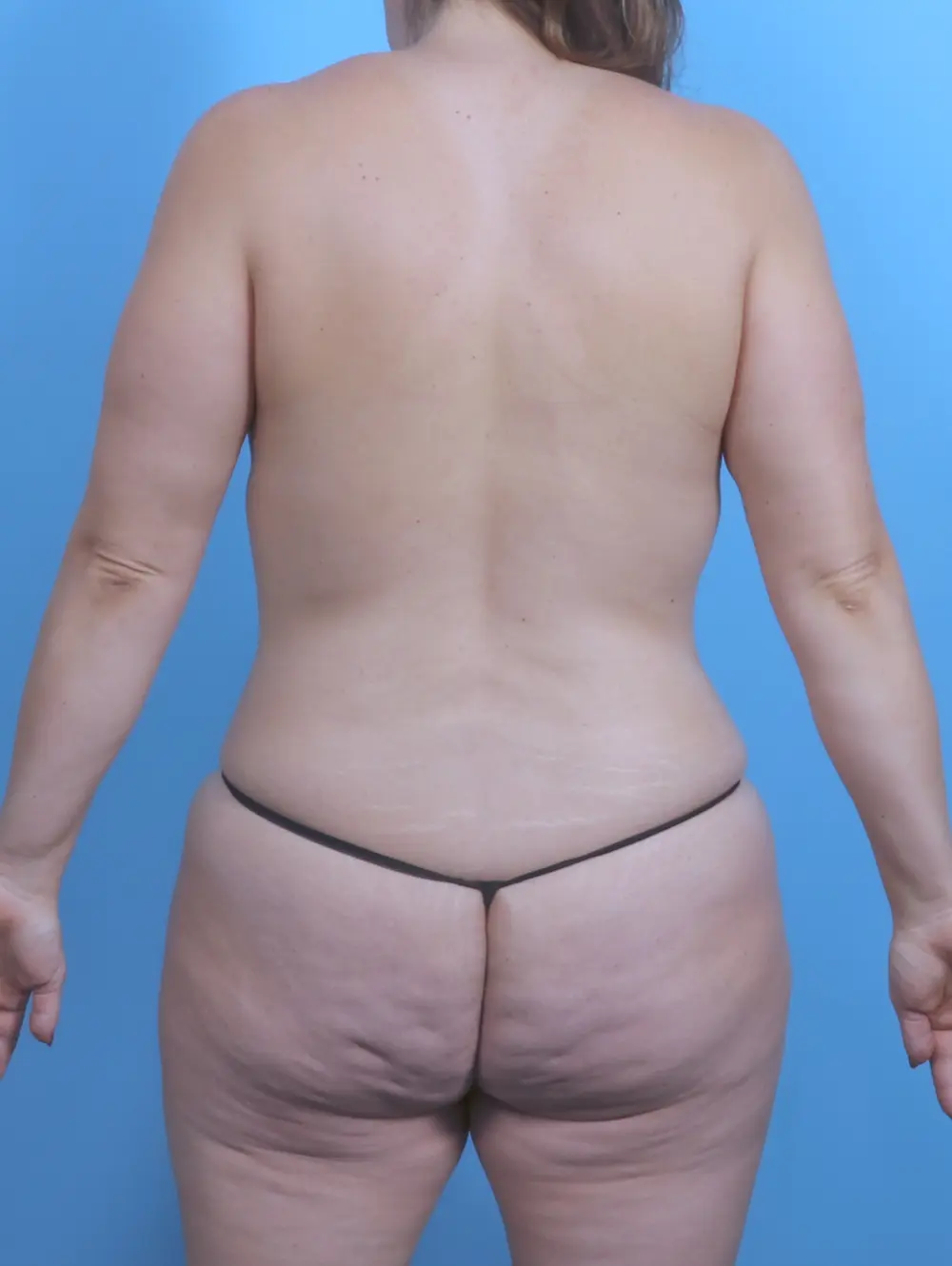 Breast Implant Revision Patient Photo - Case 47763 - before view-3