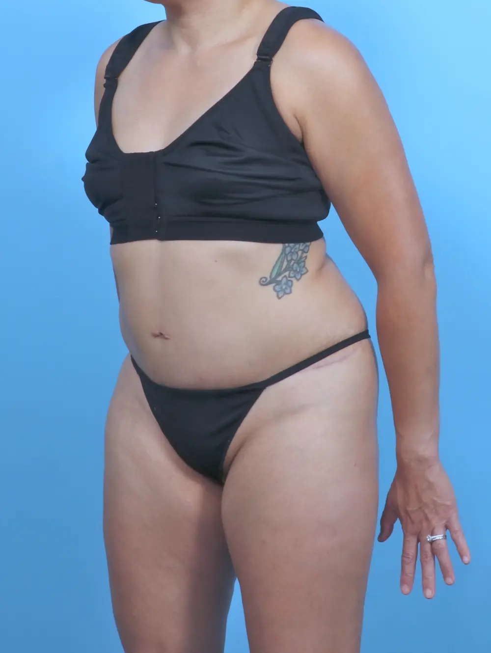 Tummy Tuck Patient Photo - Case 47773 - after view-1