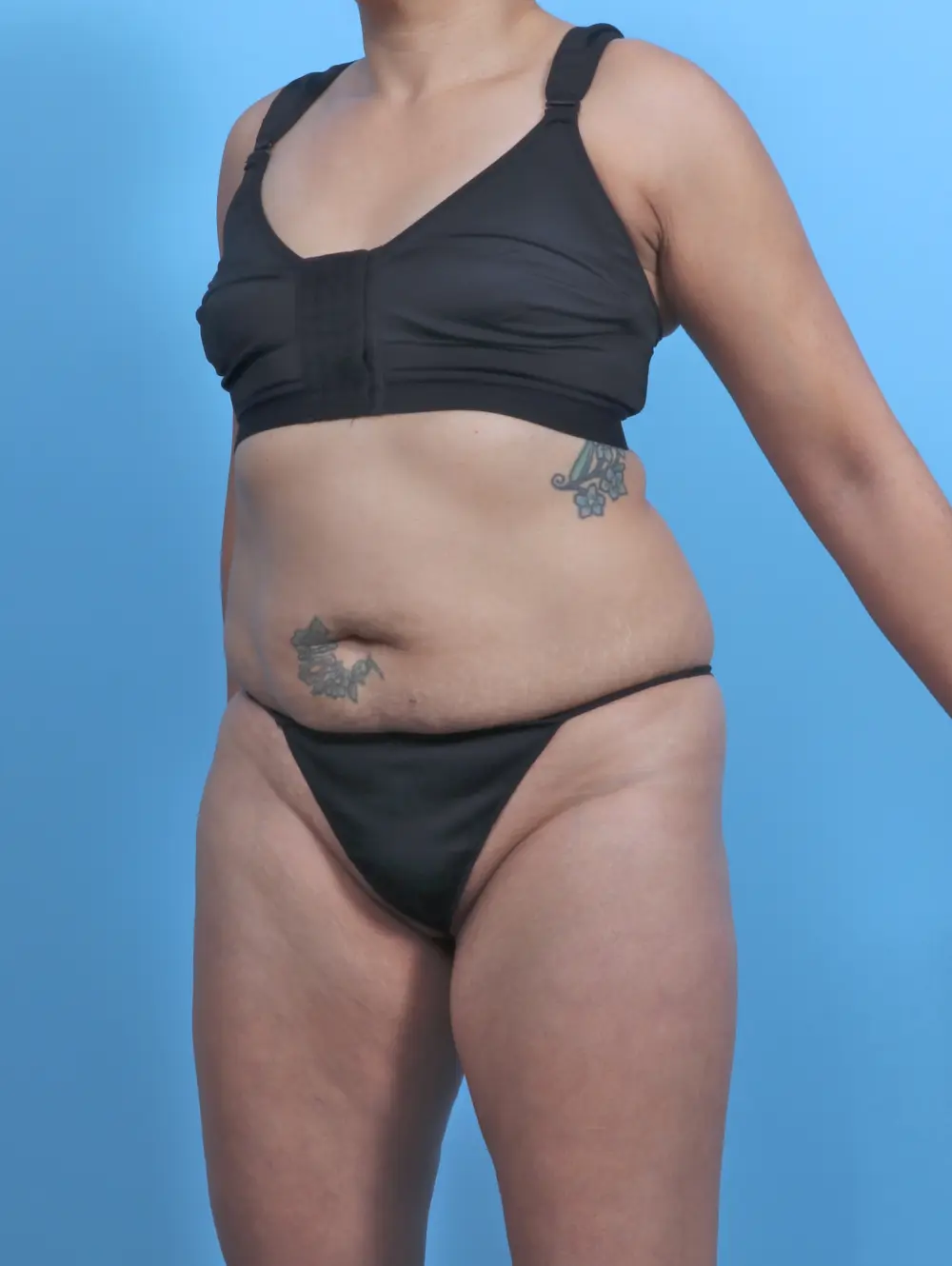 Tummy Tuck Patient Photo - Case 47773 - before view-1