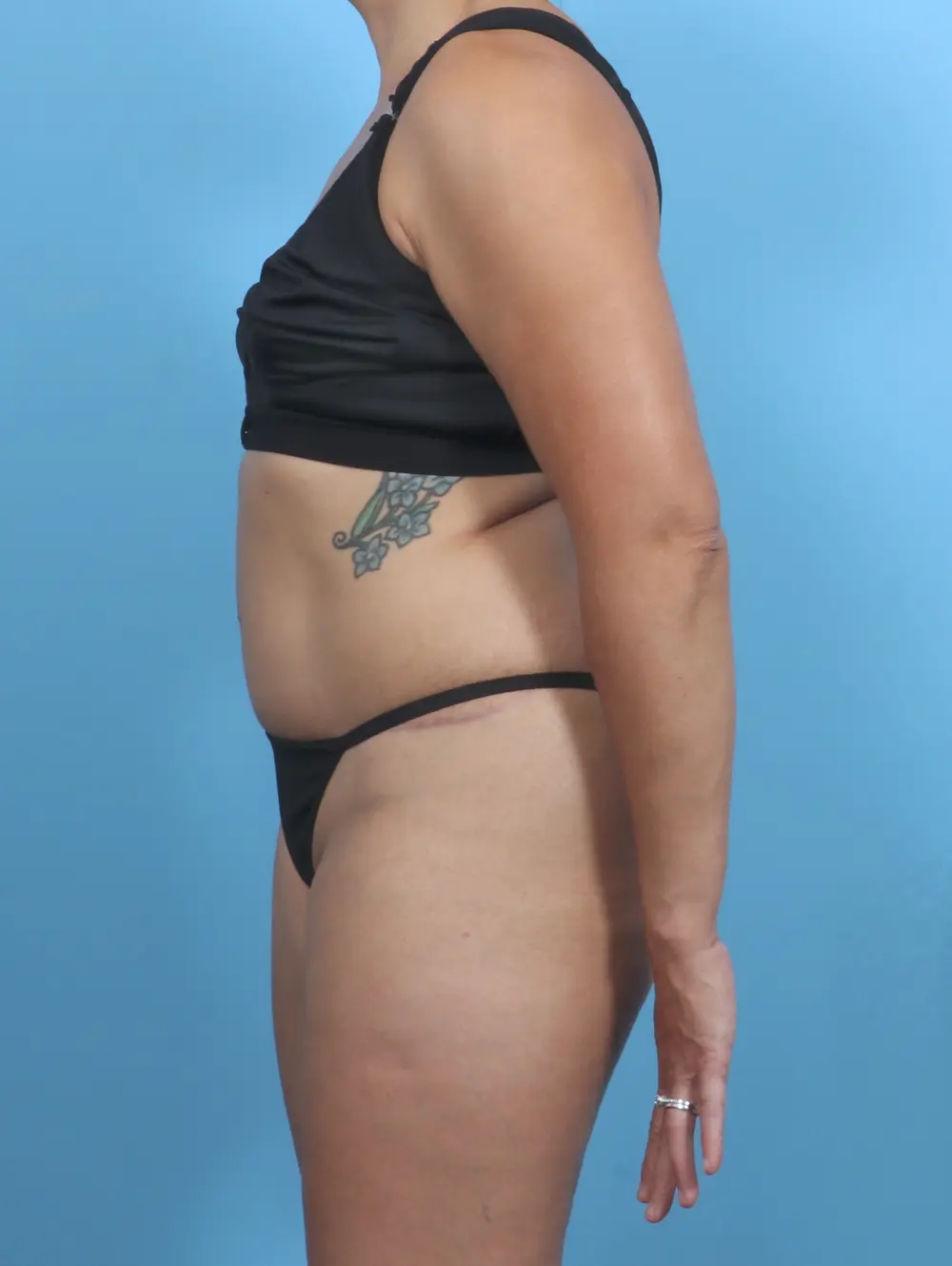 Tummy Tuck Patient Photo - Case 47773 - after view-2