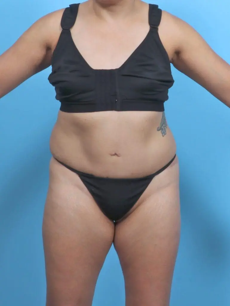 Tummy Tuck - Case 47773 - After