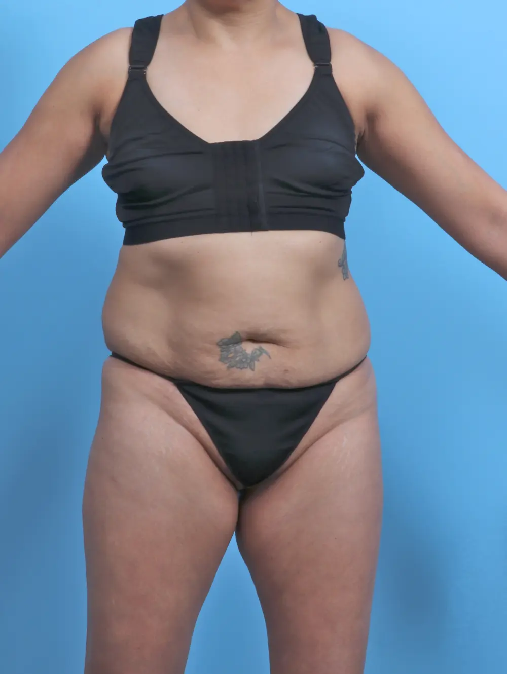 Tummy Tuck Patient Photo - Case 47773 - before view-