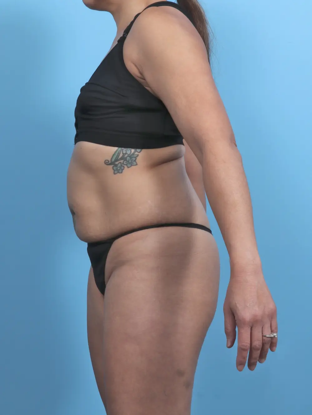 Tummy Tuck Patient Photo - Case 47773 - before view-2