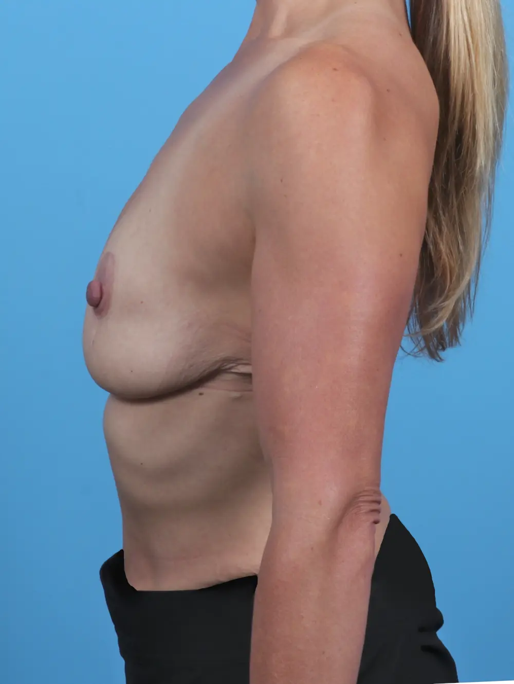 Breast Implant Revision Patient Photo - Case 47781 - before view-2