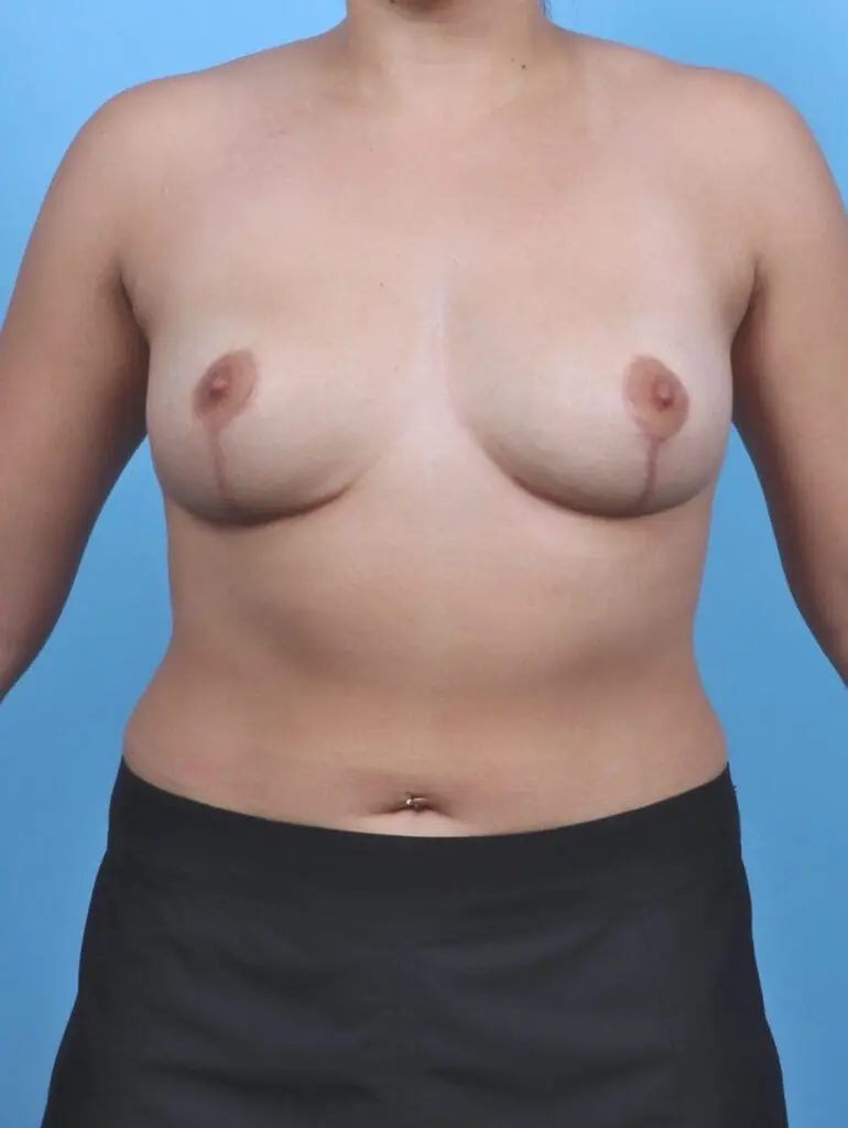 Breast Implant Removal - Case 47813 - After