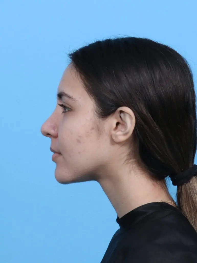 Rhinoplasty - Case 47837 - After