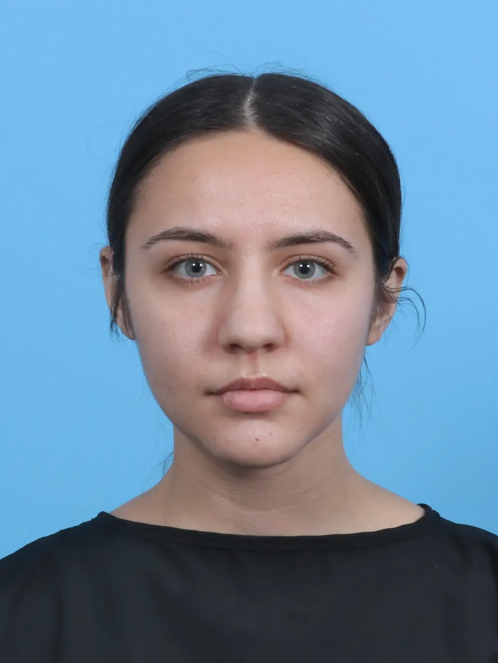 Rhinoplasty Patient Photo - Case 47837 - before view-2