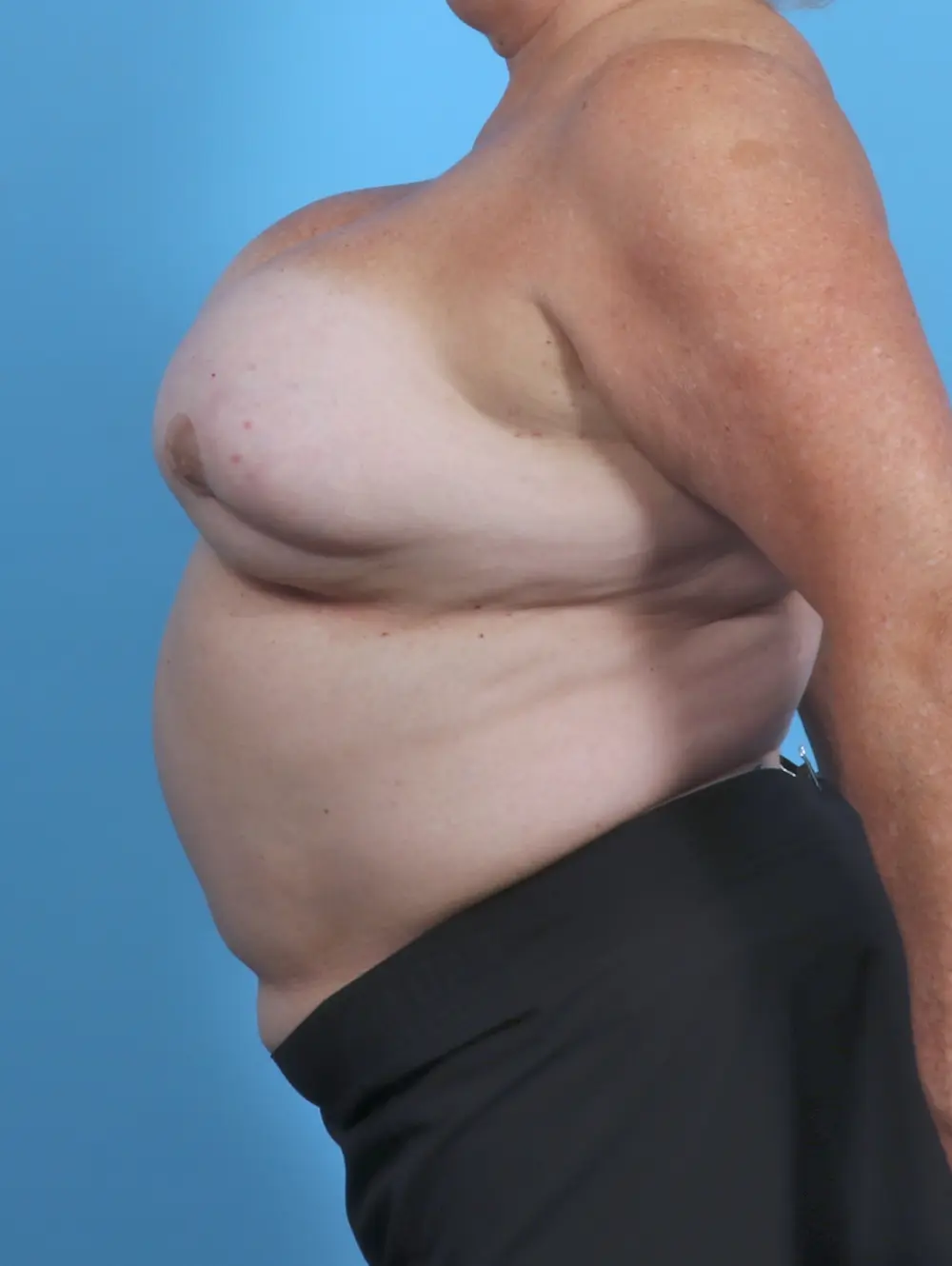 Breast Implant Revision Patient Photo - Case 47846 - before view-2