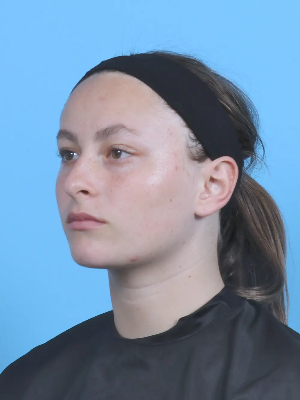 Rhinoplasty Patient Photo - Case 47855 - before view-1