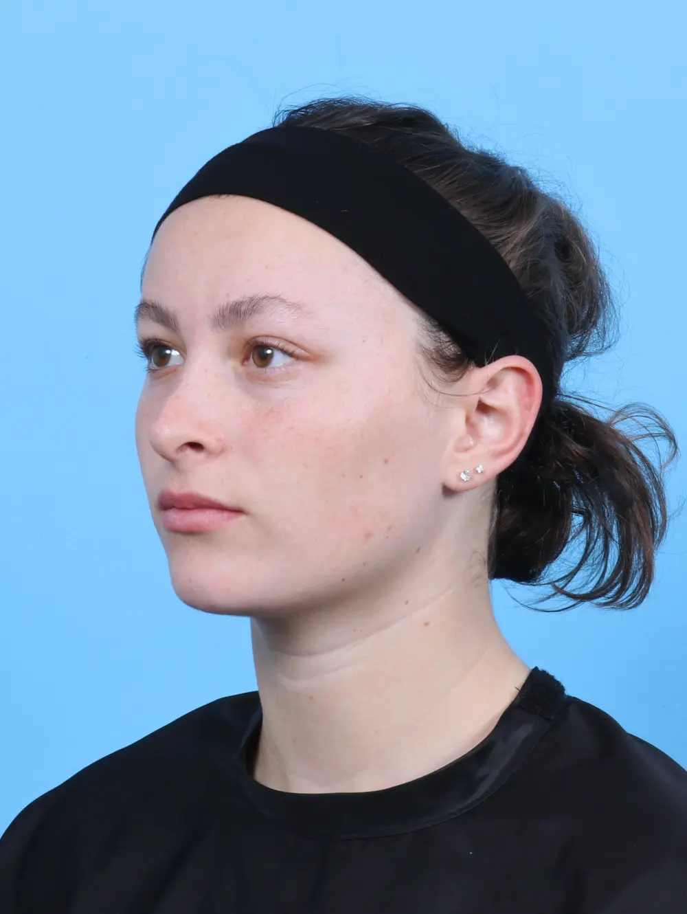 Rhinoplasty Patient Photo - Case 47855 - after view-1