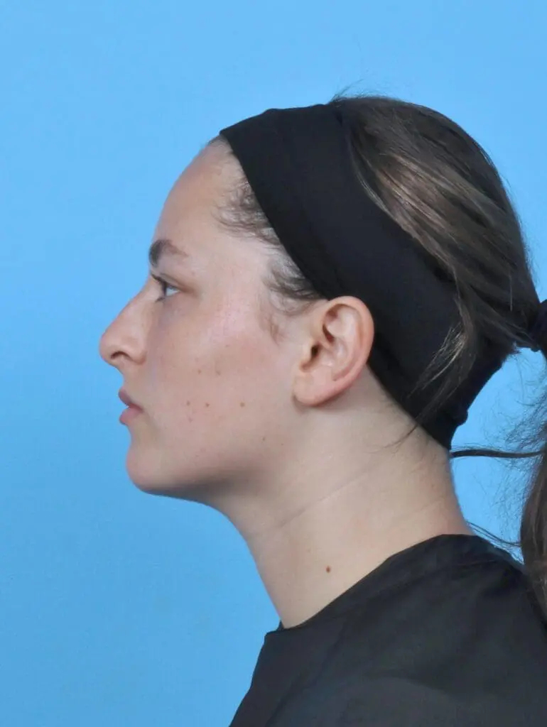 Rhinoplasty - Case 47855 - Before