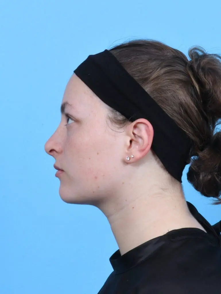 Rhinoplasty - Case 47855 - After