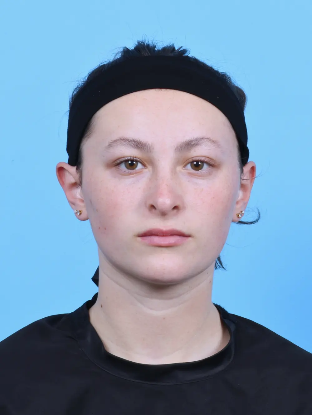 Rhinoplasty Patient Photo - Case 47855 - after view-2