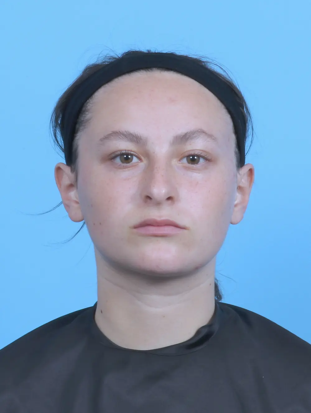 Rhinoplasty Patient Photo - Case 47855 - before view-2