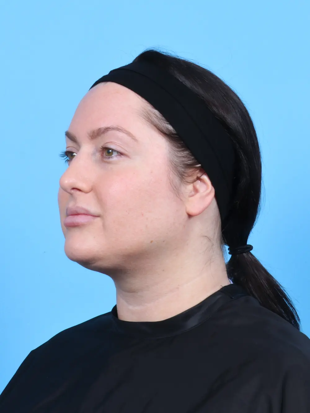 Liposuction Patient Photo - Case 47863 - after view-1