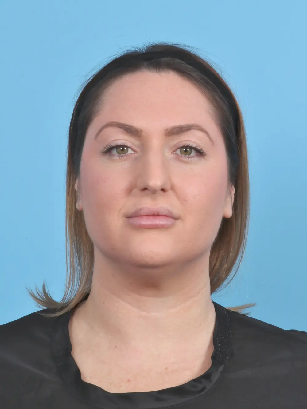 Liposuction Patient Photo - Case 47863 - before view-2