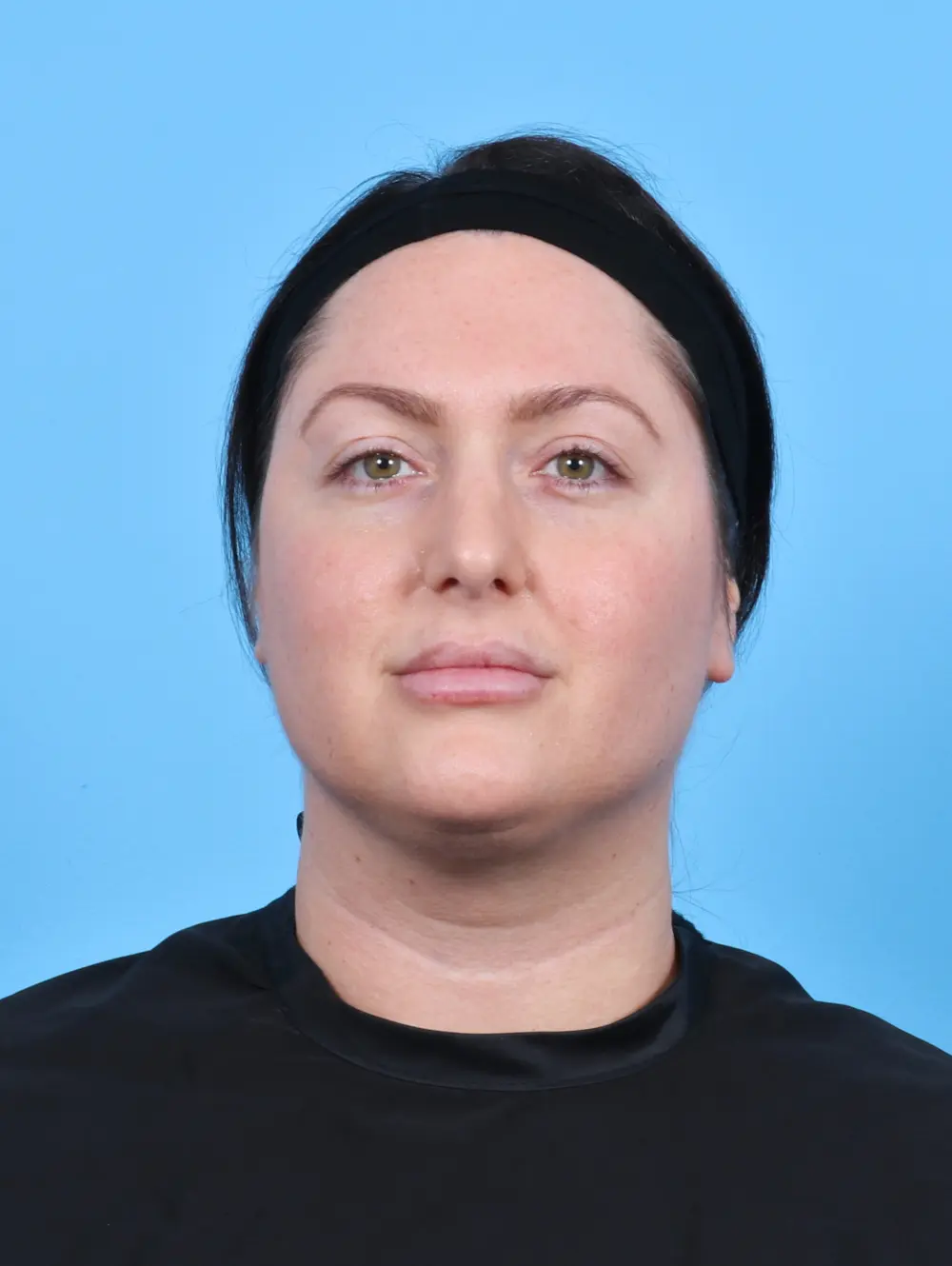 Liposuction Patient Photo - Case 47863 - after view-2